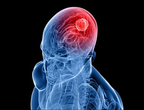 أعراض سرطان الدماغ… الأنواع مع العوامل الخطر