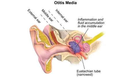 أسباب التهاب الأذن الوسطى وأعراضها وطرق العلاج