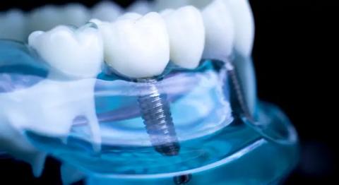 ما هي فوائد زراعة الأسنان؟