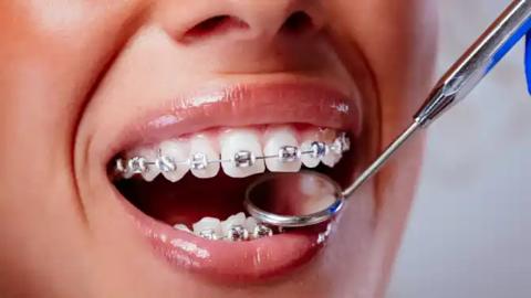 نصائح لتقويم الأسنان – أهم 20 نصيحة للحفاظ على